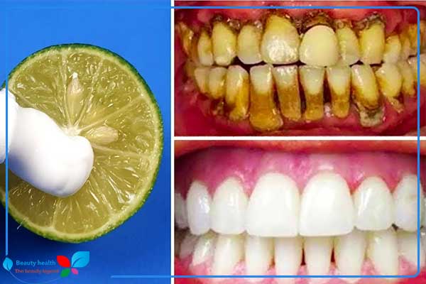 Aanbiedingen voor het bleken van tanden