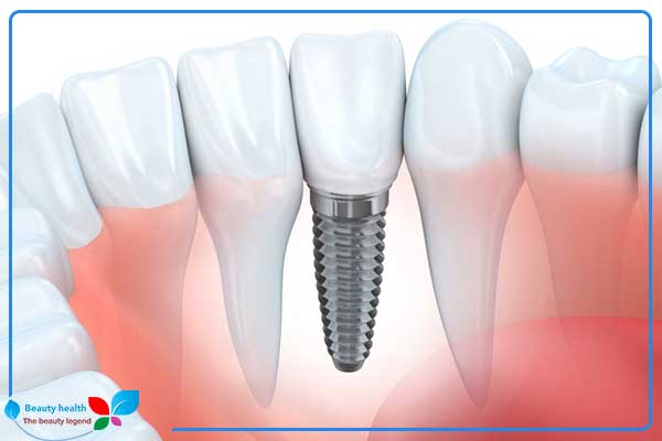 Implantes dentários na Turquia