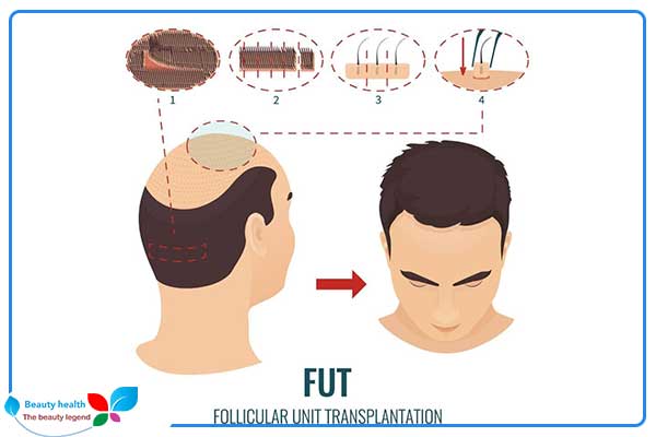 Operações de transplante de cabelo na Turquia