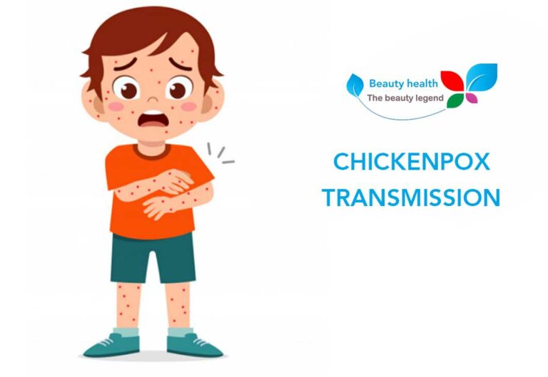 Chickenpox transmission
