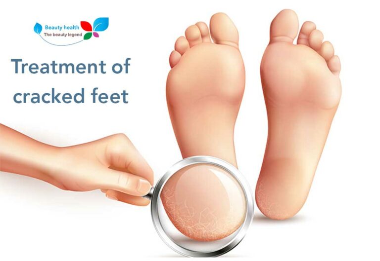 Treatment of cracked feet