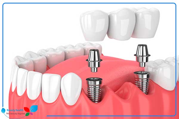 Зъбни импланти в Турция