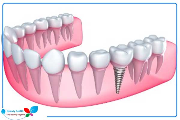 Implanty dentystyczne w Turcji