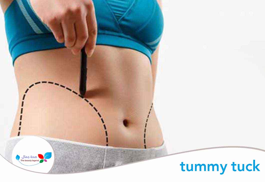 medical word for tummy tuck