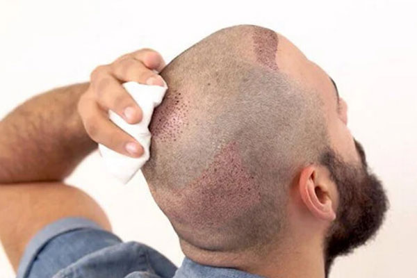 Hair transplant operations in Turkey