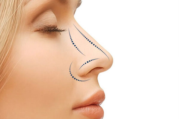 Rhinoplasty in Turkey