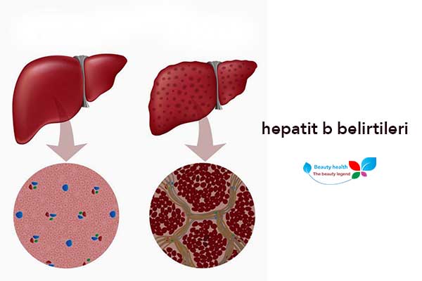 hepatit b belirtileri