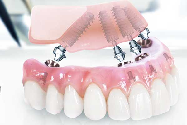 full-mouth-dental-implants-turkey-package-deals