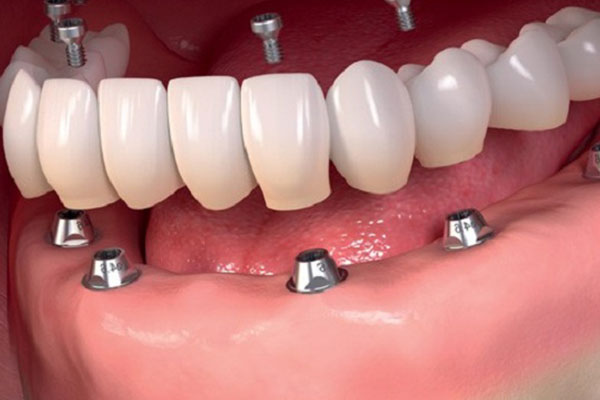 Dental Implants in Turkey