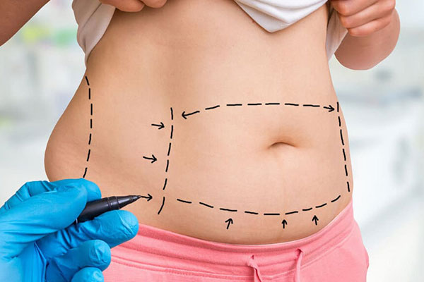 Liposuction in Turkey