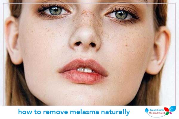 how to remove melasma naturally