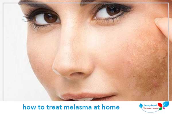 how to treat melasma at home