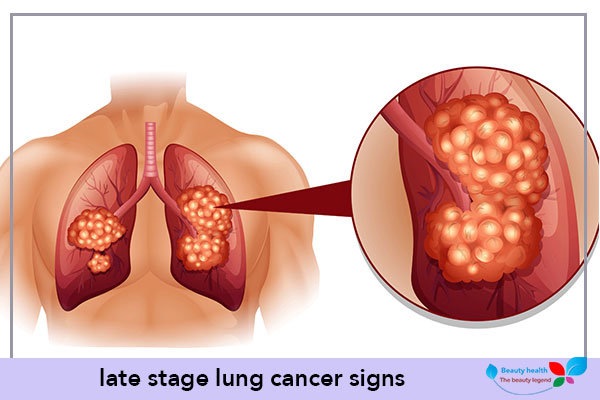 late stage lung cancer signs