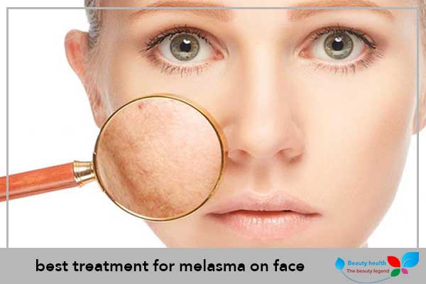best treatment for melasma on face