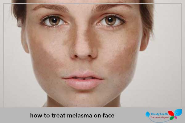 how to treat melasma on face
