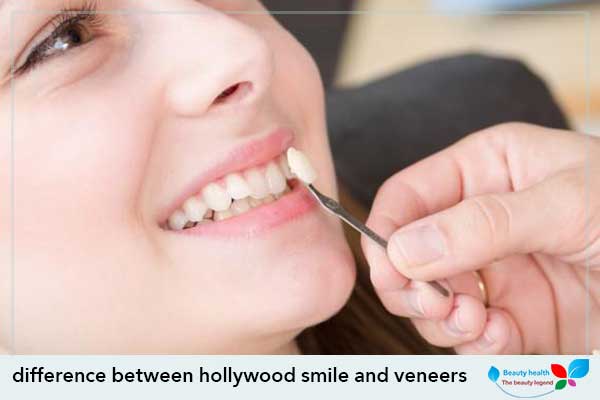 difference between hollywood smile and veneers