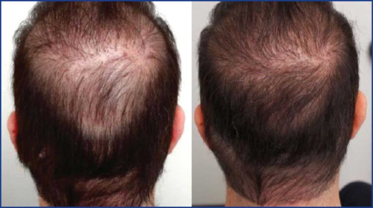 hair-transplant-cost-in-turkey