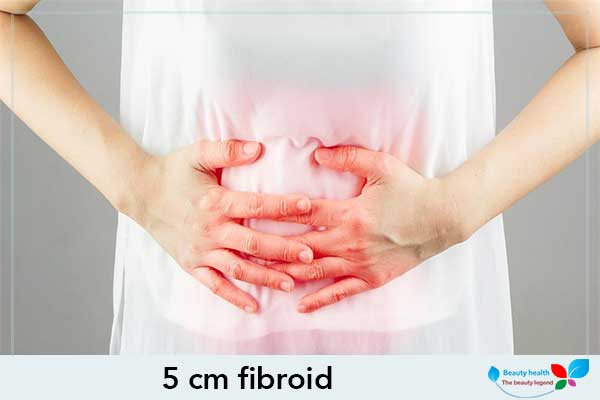 5 cm fibroid