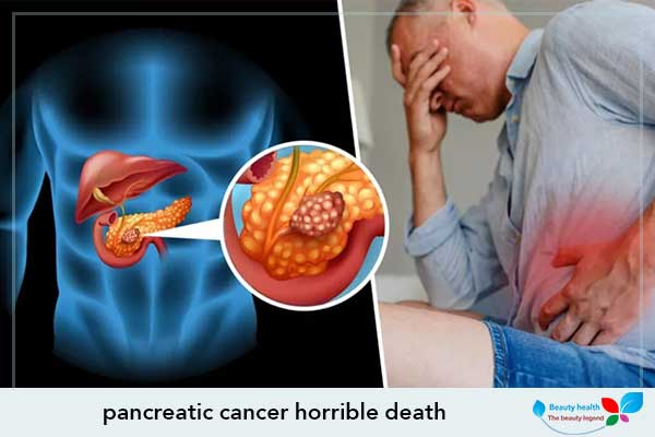 Pancreatic Cancer Horrible Death | Health Beauty