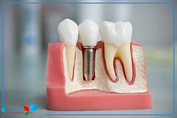implanty zębów turcja cena