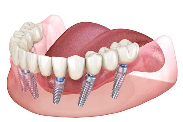 full-mouth-dental-implants-cost-turkey