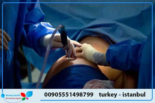 أفضل مركز شفط الدهون في تركيا - best clinic in turkey for liposuction