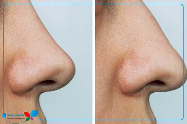 como tener la nariz perfecta naturalmente – 4 ejercicios y 6 recetas para una nariz bonita