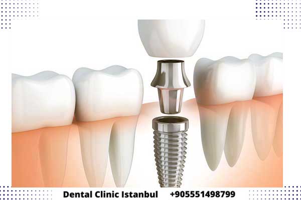 أنواع زراعة الأسنان في تركيا – دليل زراعة الاسنان في تركيا