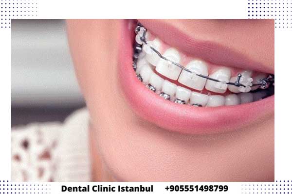تقويم الاسنان في تركيا خيارات متنوعة وأسعار مناسبة للجميع