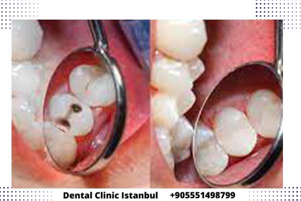 حشو الأسنان في تركيا مميزات وعيوب كل نوع وطرق التركيب