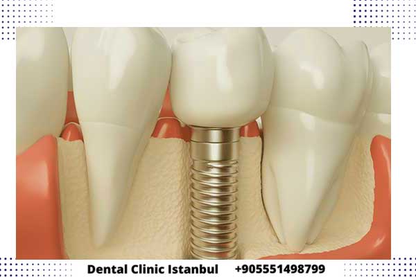 implantes dentales en turquía precios