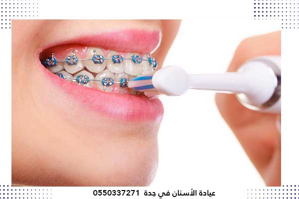 اسعار عروض تقويم الاسنان في جدة السعودية – أفضل طبيب و عيادة