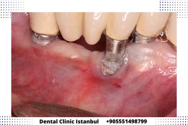 implantes dentales en turquía