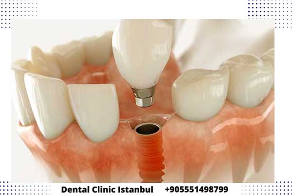 Implantes Dentales en Turquía: Experiencias y Opiniones de Pacientes Satisfechos