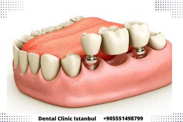 Precio de Implantes Dentales para Toda la Boca en Turquía: Una Opción Accesible para Sonrisas Completas