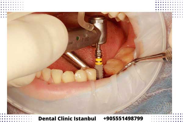 precio implantes dentales en estambul