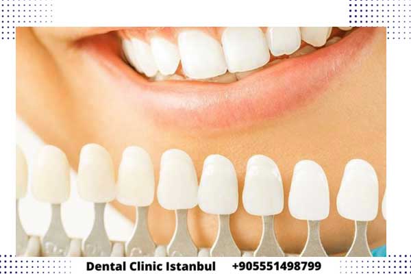 Carillas Dentales en Turquía: Logrando Sonrisas Deslumbrantes a un Precio Asequible