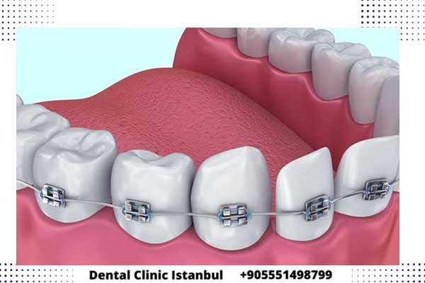 tratamiento dental turquia