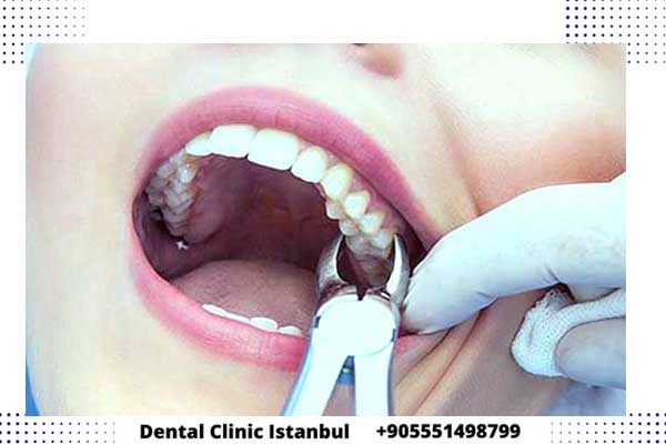 Nuevos Dientes en Turquía: Sonrisas Renovadas con Excelencia Odontológica