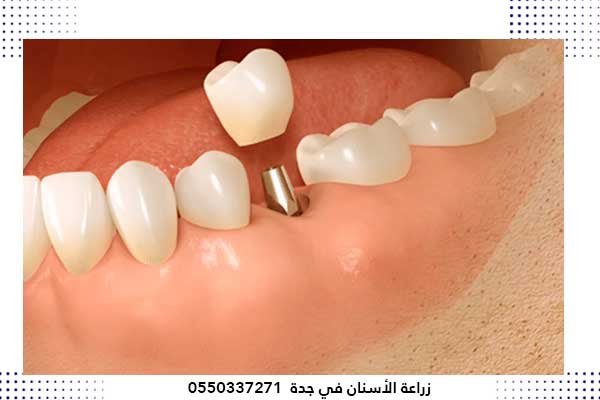 عروض اسعار زراعة الاسنان في جدة السعودية – أفضل طبيب و عيادة