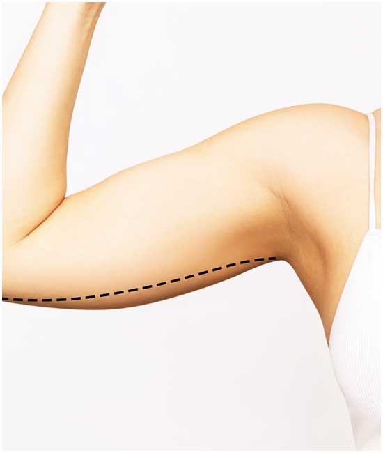 Braquioplastia (cirurgia de levantamento de braço na Turquia)
