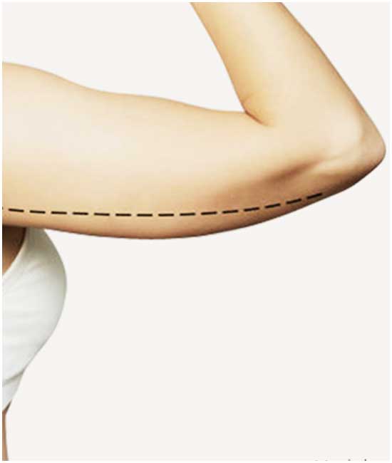 Brachioplasty (Arm Lift Surgery in Turkey)