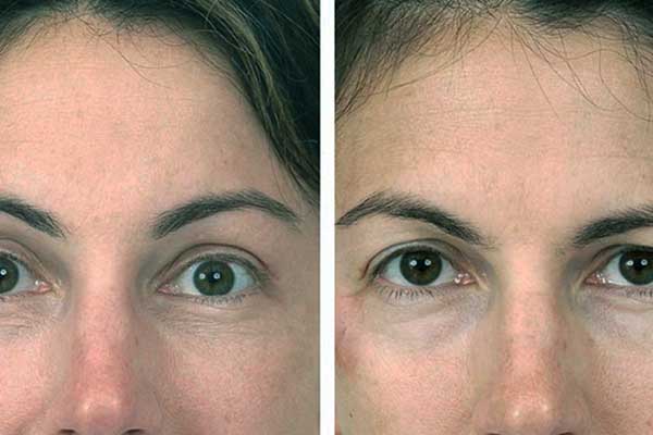 Brow Lift and Mini Facelift