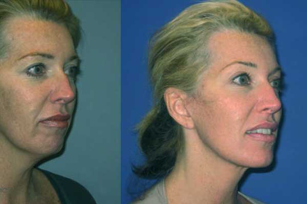 Brow Lift and Mini Facelift