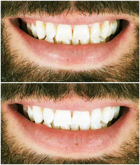 Зъбна коронка