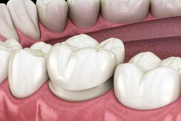 Coronas dentales en Turquía