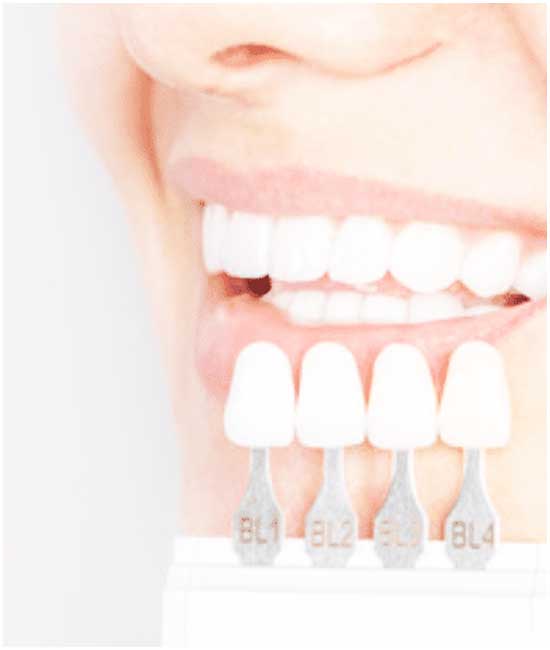 قشور الأسنان في تركيا: أفضل تجميل للأسنان