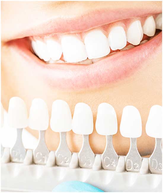 قشور الأسنان في تركيا: أفضل تجميل للأسنان