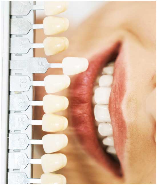Facettes dentaires en Turquie : meilleure relooking dentaire