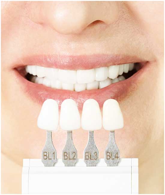 ציפוי שיניים בטורקיה: מהפך השיניים הטוב ביותר